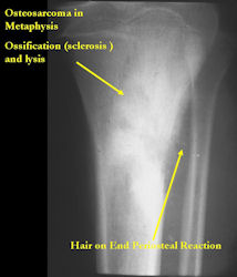 X Ray Osteosarcoma