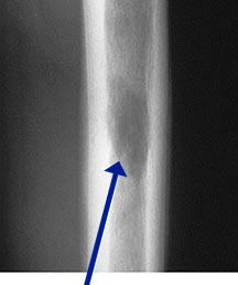 X-ray: Eosinophilic Granuloma of Femur
