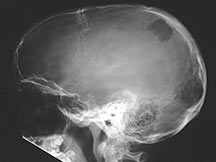 X-Ray: Eosinophilic Granuloma of Skull