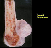 Gross specimen: parosteal osteosarcoma, distal femur