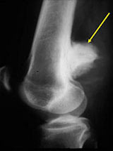 Lateral radiograph and CT: Parosteal osteosarcoma of distal femur 