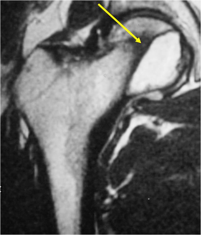 MRI T2 Weighted Image