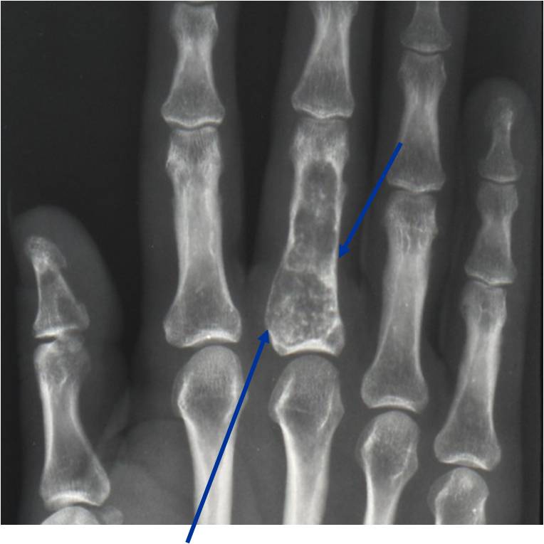 Plain X-Ray: Enchondroma of Proximal Phalanx