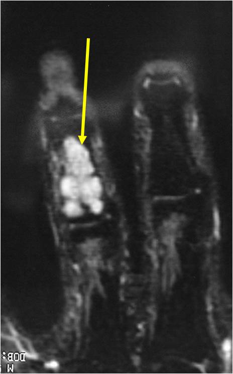 X-Ray and MRI of Enchondroma of Middle Phalanx