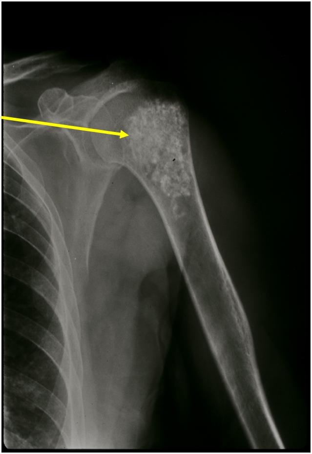 Plain X-Ray: Enchondroma of Proximal Humerus