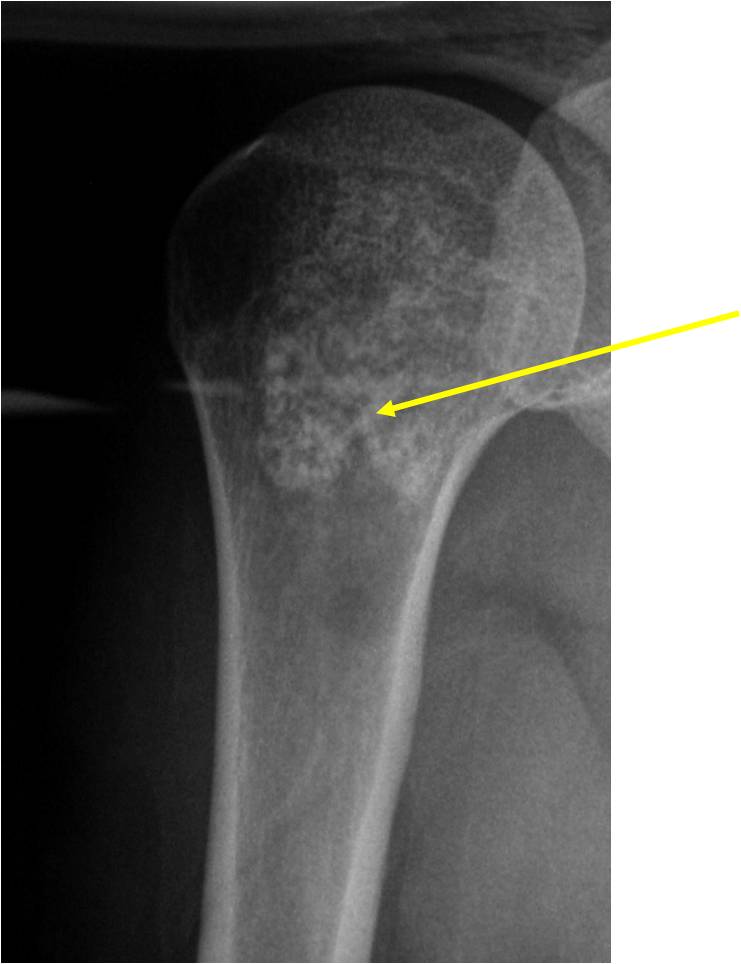 Plain X-Ray:  Enchondroma of Proximal Humerus