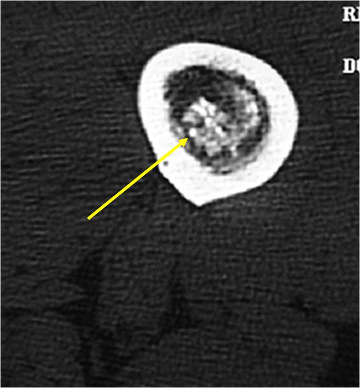 X-Ray and CT Scan: Enchondroma of Femur