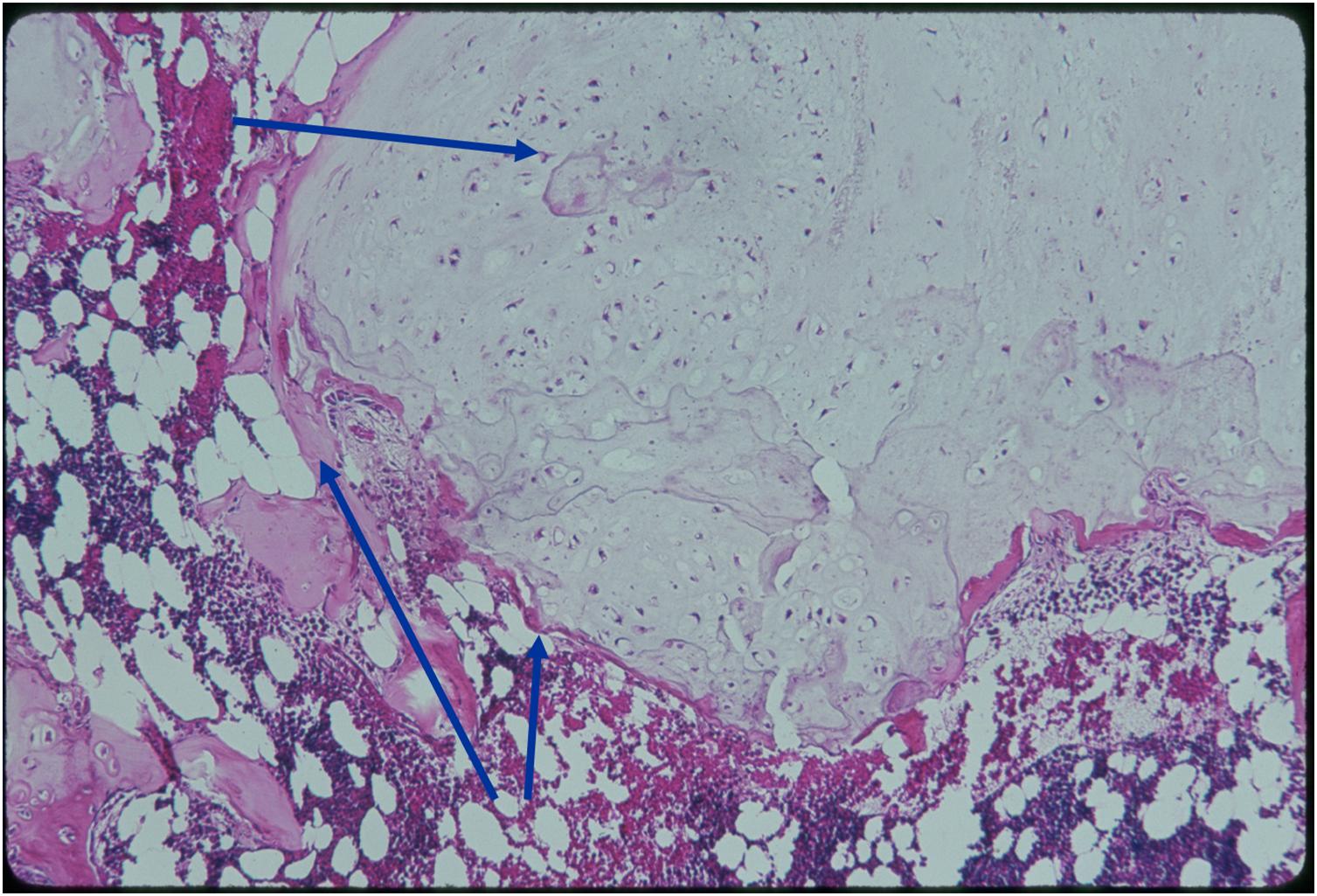 Microscopic Pathology:  Enchondroma 