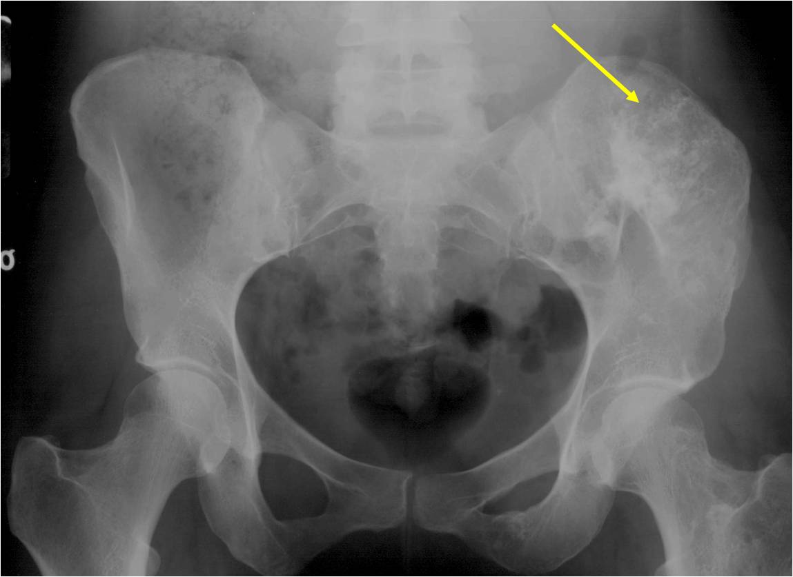 Plain X-ray: Enchondromatosis of Pelvis Maffucci's Syndrome