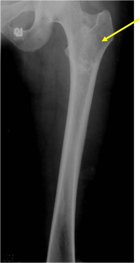 Plain X-rays: Enchondromatosis Maffucci's Syndrome