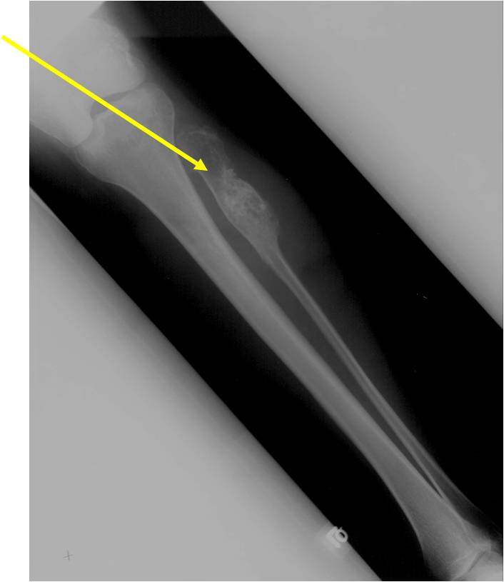 Plain X-rays: Enchondromatosis Maffucci's Syndrome