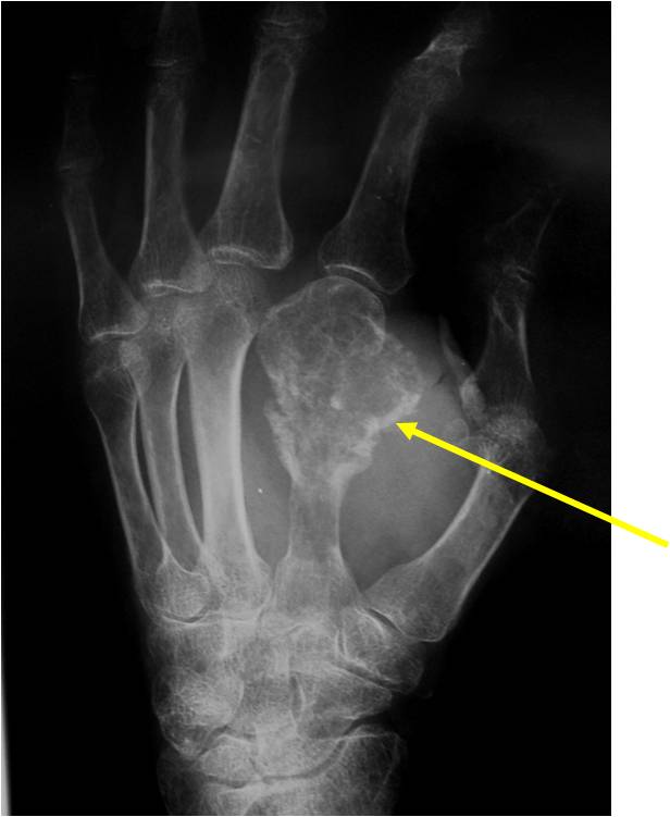 Example of Chondrosarcoma of Metacarpal of Hand