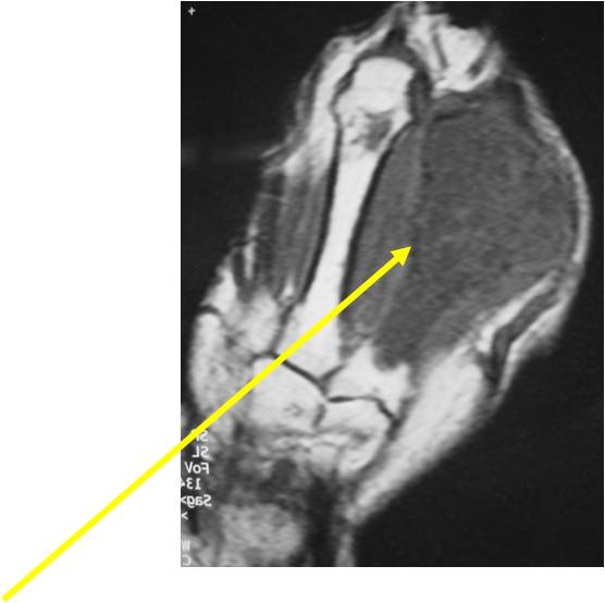 Example of Chondrosarcoma of Metacarpal of Hand
