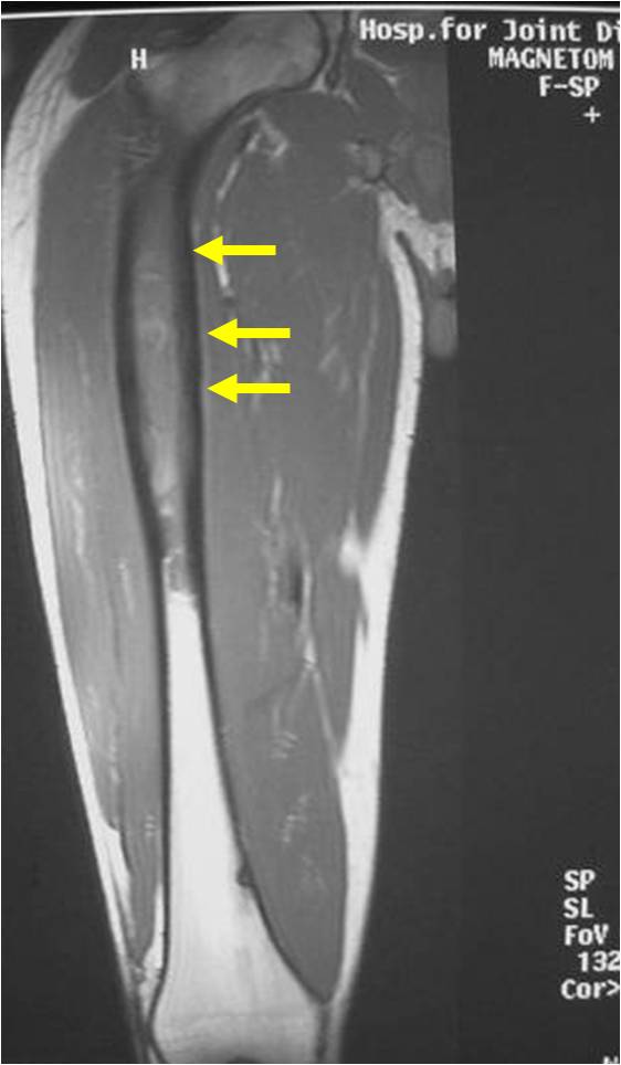 MRI T1 Weighted Image: Ewing Sarcoma of Right Proximal Femur