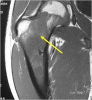 MRI T1 Weighted Image: Ewing Sarcoma of Right Proximal Femur (Arrow) Hip Involvement