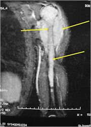 MRI T2: Ewing Sarcoma of Left Humerus