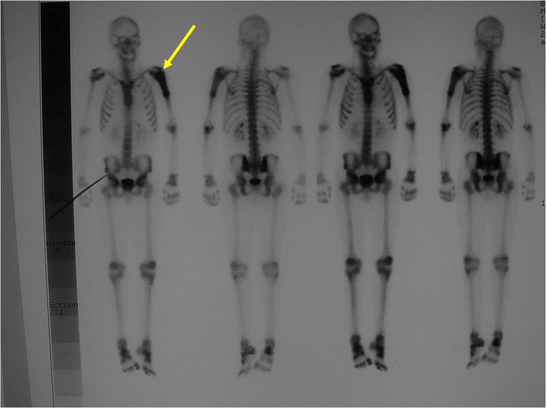 Bone Scan: Ewing Sarcoma of Left Humerus demonstrates Intense Uptake