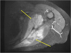 MRI: Ewing Sarcoma of Scapula
