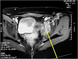 MRI/CT Scan: Ewing Sarcoma of Left Acetabulum/Superior Pubic Ramus