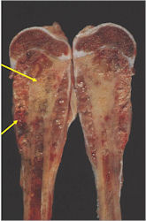 Gross Pathology: Ewing Sarcoma of Metadiaphysis of Proximal Humerus