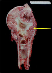 Gross Pathology: Ewing Sarcoma of Proximal Humerus Metadiaphysis