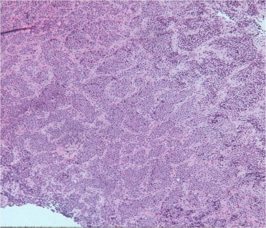 Microscopic Pathology: Ewing Sarcoma