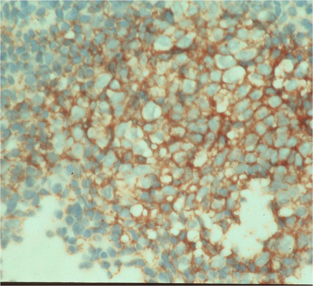 Ewing Sarcoma: CD99 Stain Positive Identifies MIC2 Overexpression