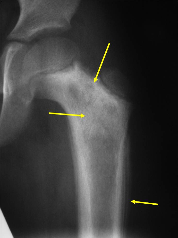 X-ray: Ewing Sarcoma of Proximal Femur