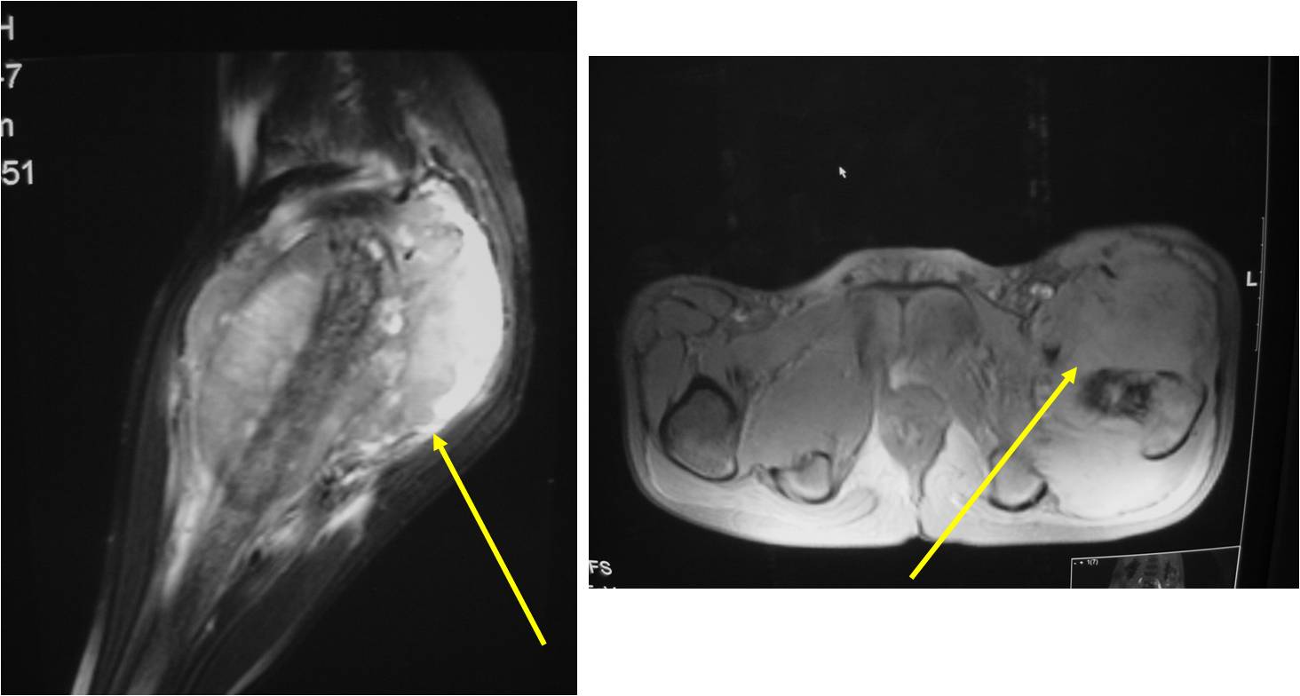 MRI:  Ewing Sarcoma of Proximal Femur