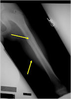 X-ray/MRI: Ewing Sarcoma of Diaphysis of Left Femur