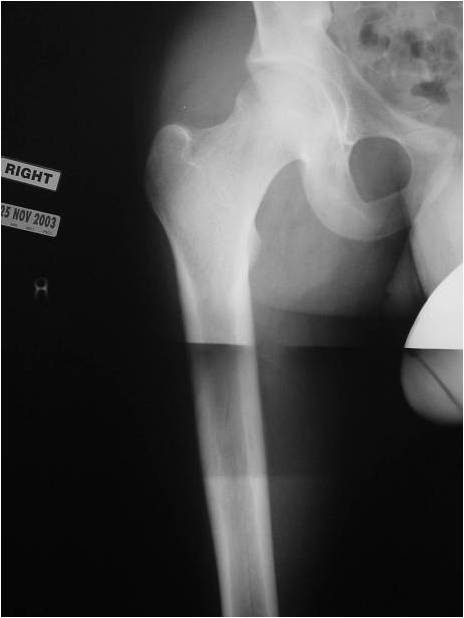 X-ray: Ewing Sarcoma of Right Femur