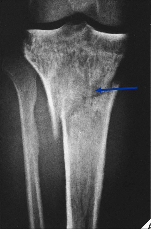 X-Ray: Primary Lymphoma of Proximal Tibia, Permeative Lesion of Proximal Tibia with Pathological Fracture