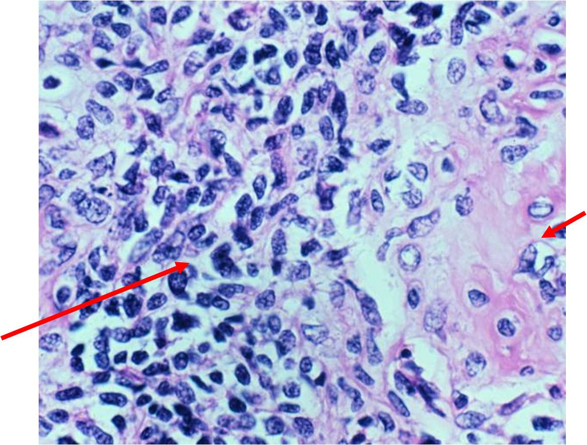 Mesenchymal Chondrosarcoma, microscopic pathology