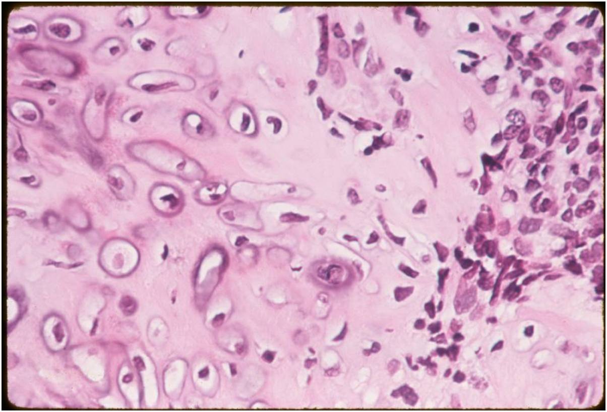 Mesenchymal (Small Round Blue Cell) Component Large Nuclei; No Cytoplasm; No Matrix