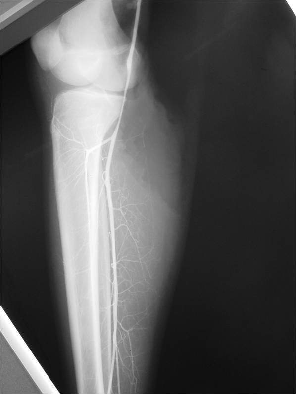 Limb Sparing Surgery for Extraskeletal Mesenchymal Chondrosarcoma of Popliteal Fossa Intraoperative Arteriogram demonstrating Patency of Popliteal Artery at Conclusion of Surgery