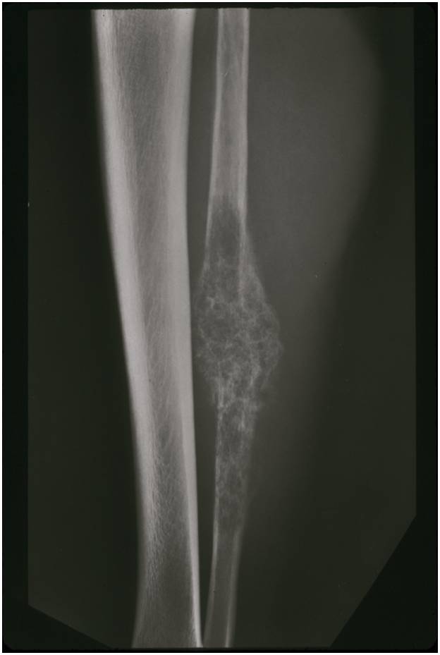 Plain X-ray: Mesenchymal Chondrosarcoma from Proximal Humerus