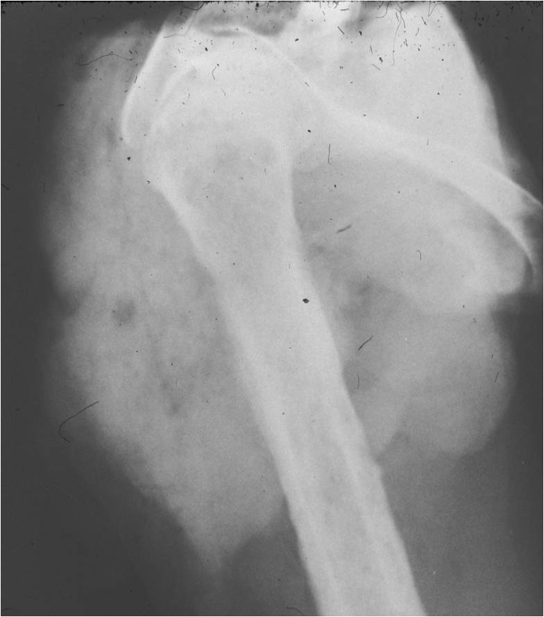 Plain X-ray: Mesenchymal Chondrosarcoma from Proximal Humerus