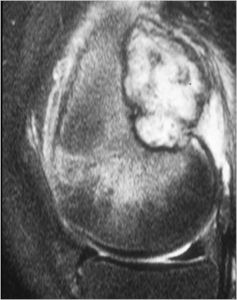 MRI: T1 Weighted Image of Osteoblastoma of Distal Femur