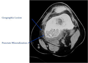 MRI: T2 Coronal MRI of Osteoblastoma of Distal Femur