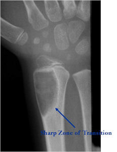 CT Scan of Distal Femur Osteoblastoma