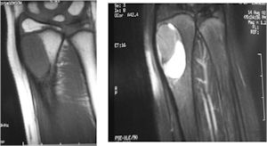 X-ray: Osteoblastoma of Distal Radius