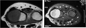 MRI: Osteoblastoma of Distal Radius