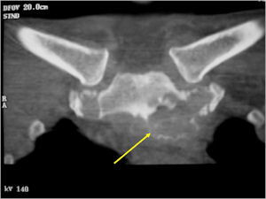 CT Scan: Osteoblastoma of Sternum Axial Section