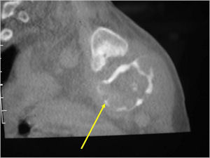 CT Scan Osteoblastoma of Sternum
            Coronal Section