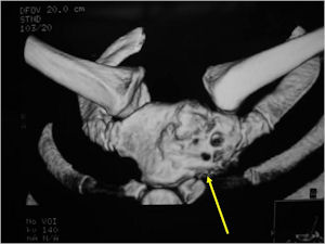 CT Scan Osteoblastoma of Sternum
            Sagittal Section
