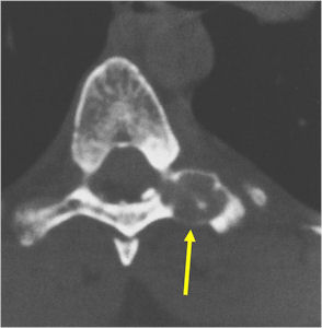 X-ray: Osteoblastoma of Proximal Phalanx