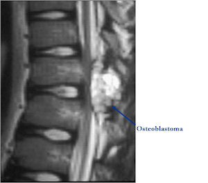 Osteoblastoma of Spine Posterior Elements