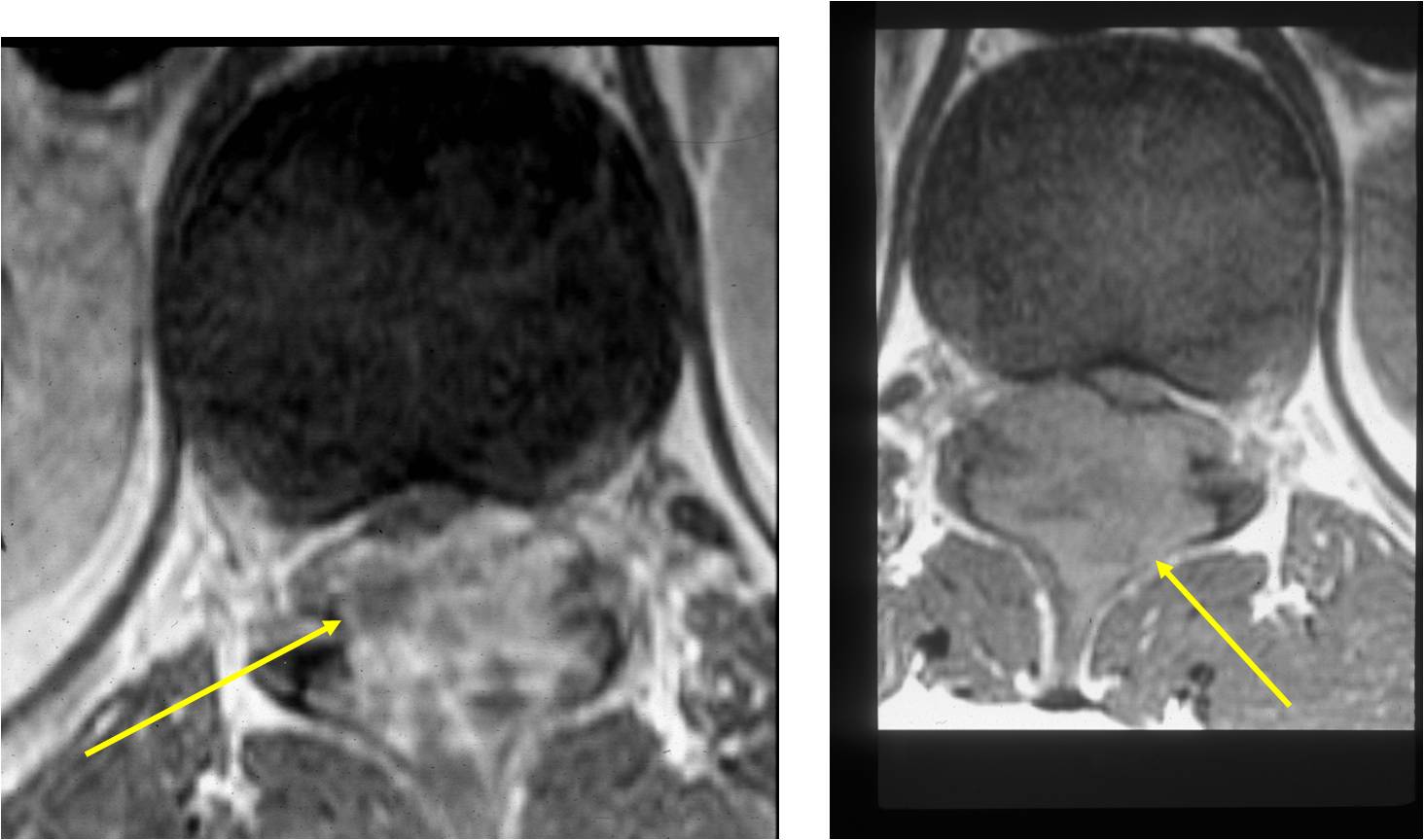 MRI: Osteoblastoma of Spine Posterior Elements