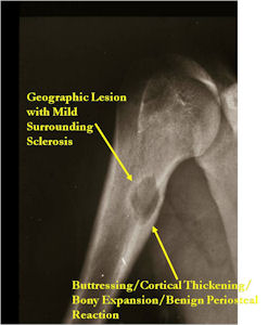 benign cancer of bone)