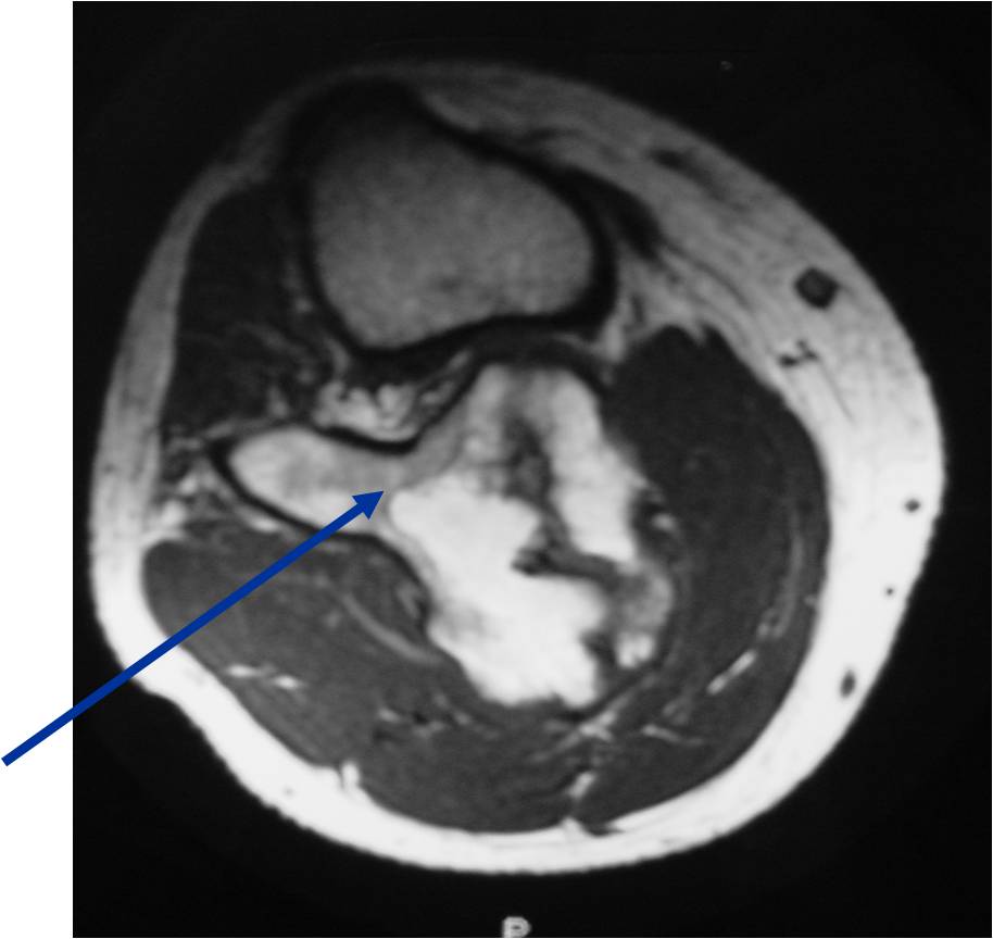 MRI of Proximal Fibula Osteochondroma Demonstrates Continuity of Medullary Canal of Fibula with Osteochondroma